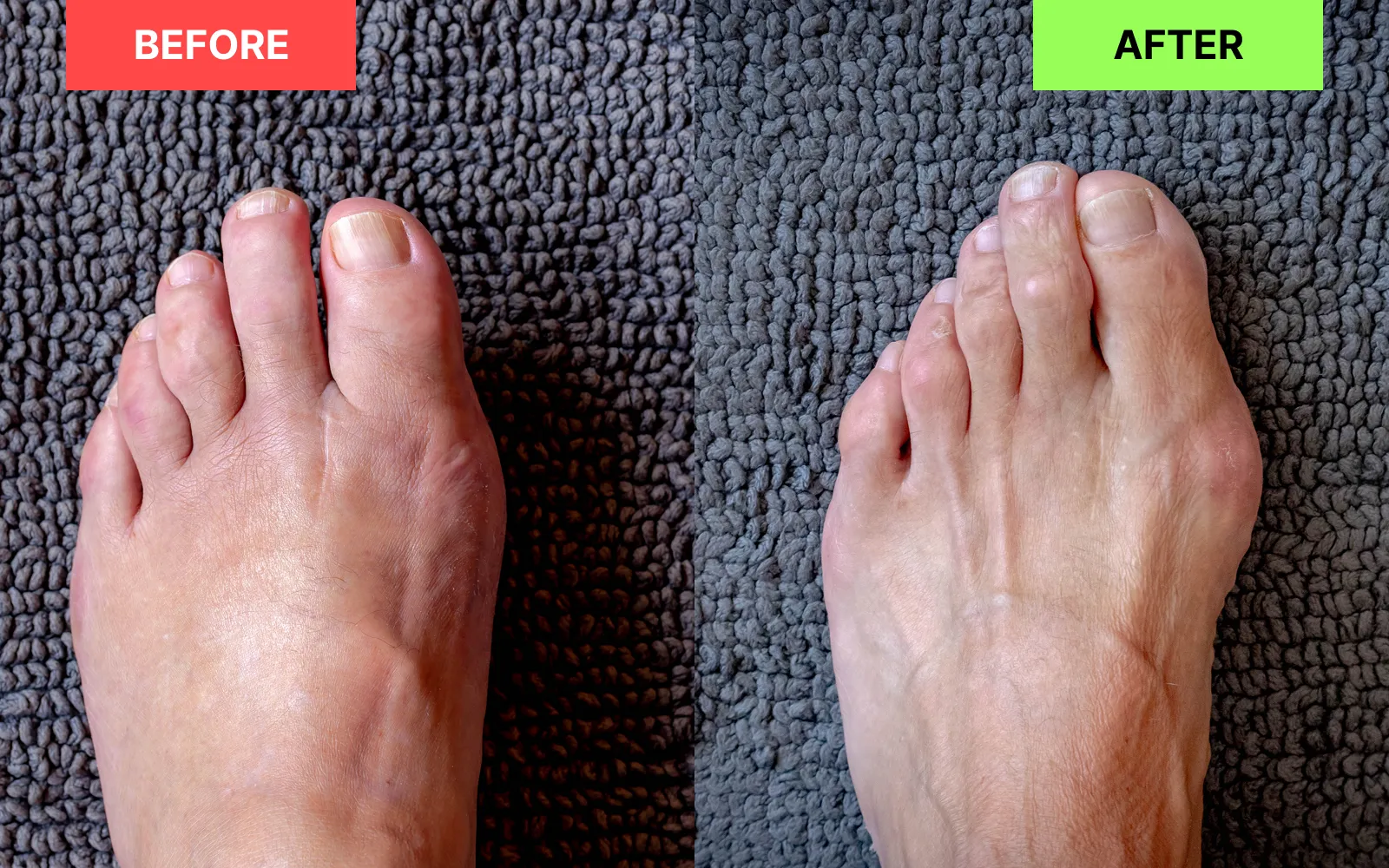 EMSense before and after results showing muscle tension relief